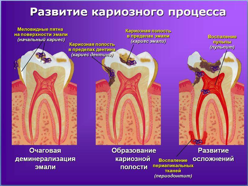 Периодонтит план лечения